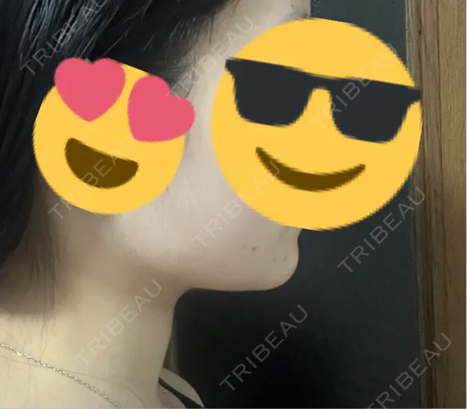 脂肪吸引（顔） Mods Clinic（モッズクリニック） 名古屋院 DAY 187 メイン用