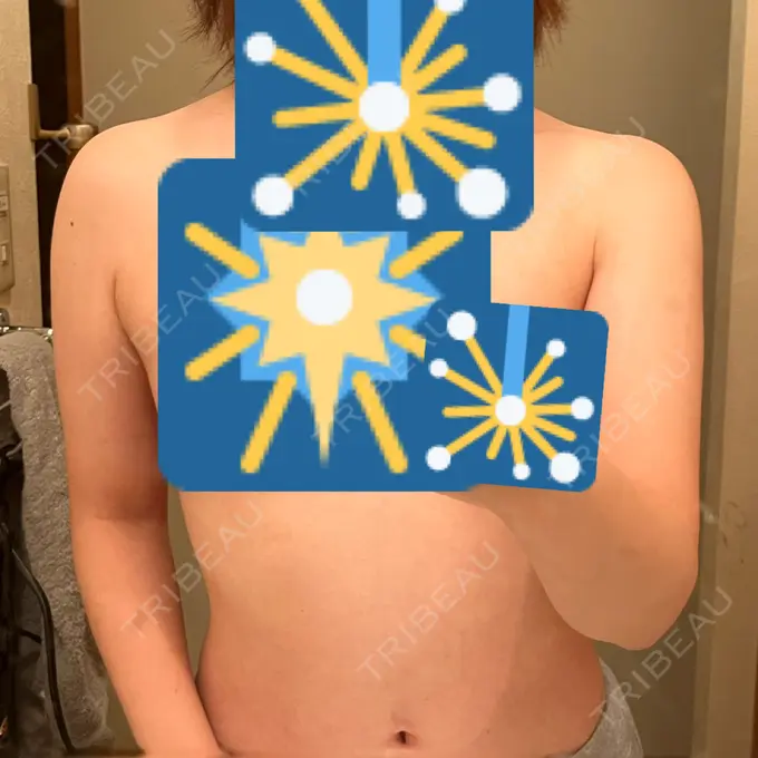 脂肪吸引（二の腕） / 脂肪吸引（肩） 湘南美容クリニック 大阪梅田本院 AFTER メイン用