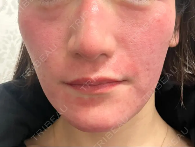 ニードルRF（ポテンツァなど） Re：HADA CLINIC 銀座 DAY 0 メイン用