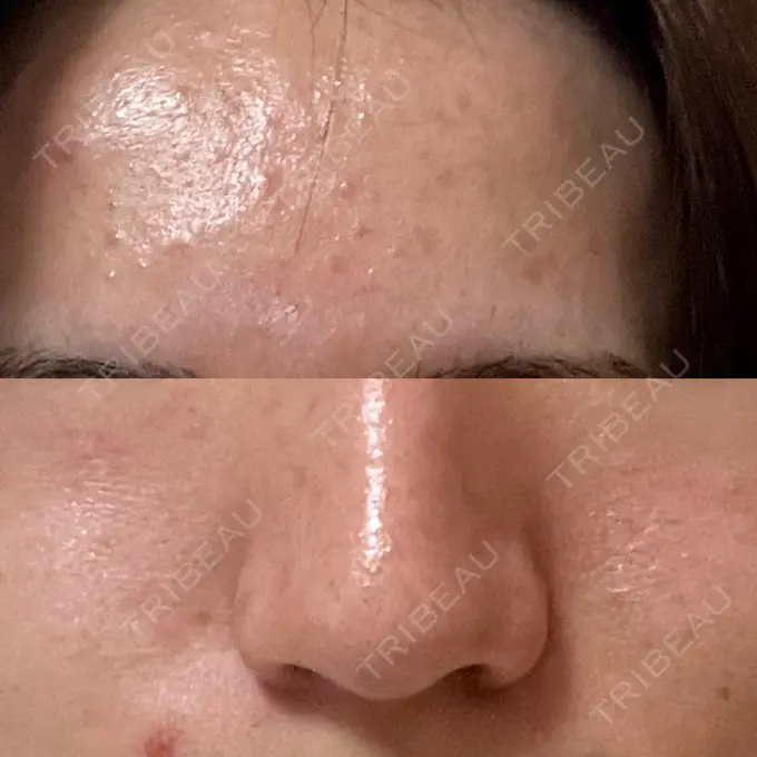 ピーリング（ニキビ・毛穴） SK新宿歌舞伎町美容外科・歯科 DAY 8 メイン用