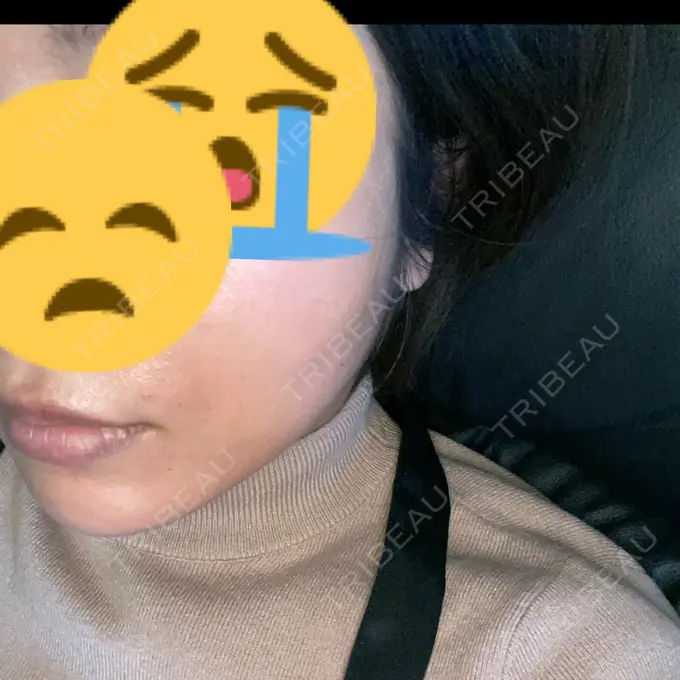 糸リフト 東京シンデレラ美容外科 池袋院 DAY 28 メイン用