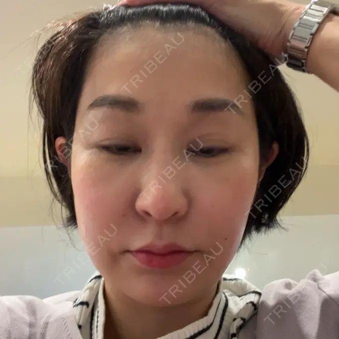 ボトックス（眉間） / ボトックス（目尻） 湘南美容クリニック 品川院 AFTER メイン用