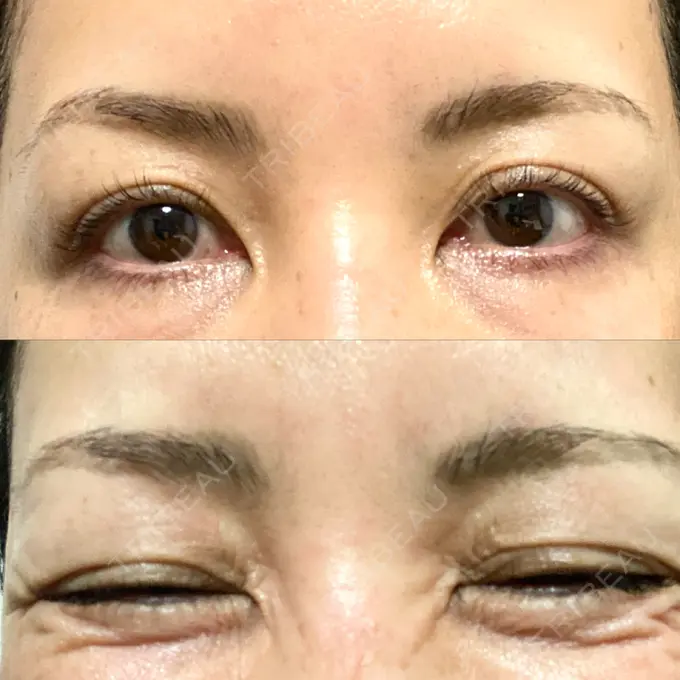 シワ取りボトックス / ボトックス（眉間） TCB東京中央美容外科 神戸院 DAY 10 メイン用