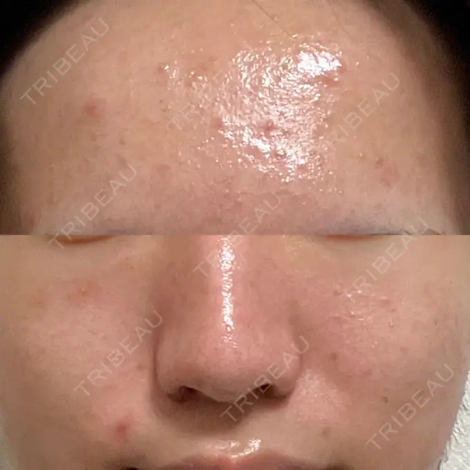 ピーリング（ニキビ・毛穴） SK新宿歌舞伎町美容外科・歯科 AFTER メイン用