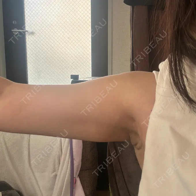 脂肪吸引（二の腕） アムルーズ美容外科クリニック 横浜院 AFTER メイン用