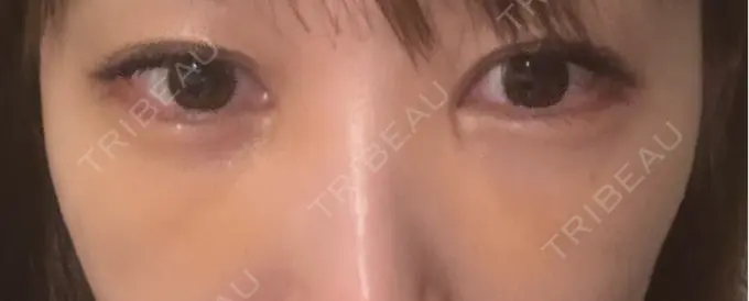 クマ治療 / 下まぶたの脂肪取り / 脂肪注入（目の下） セオリークリニック DAY 6 メイン用