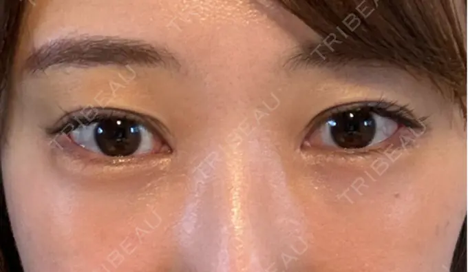 クマ治療 / 下まぶたの脂肪取り / 脂肪注入（目の下） セオリークリニック DAY 9 メイン用