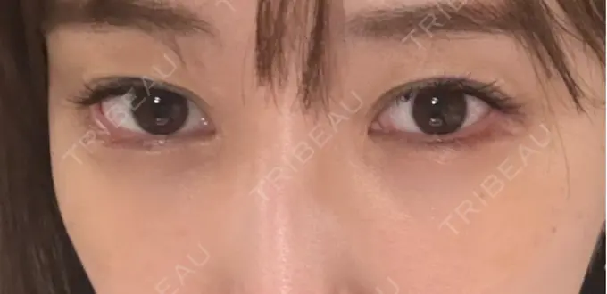 クマ治療 / 下まぶたの脂肪取り / 脂肪注入（目の下） セオリークリニック DAY 11 メイン用