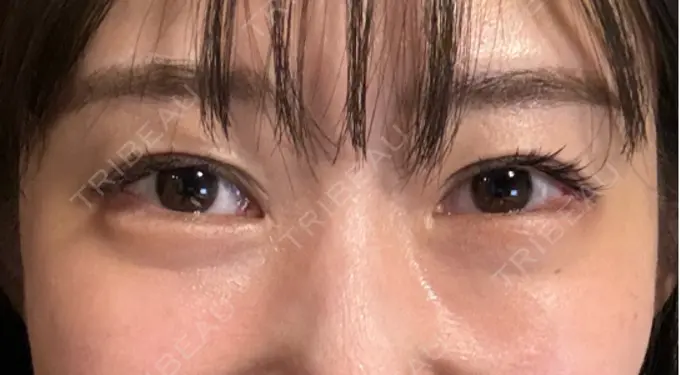 クマ治療 / 下まぶたの脂肪取り / 脂肪注入（目の下） セオリークリニック DAY 12 メイン用