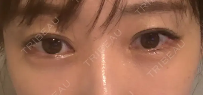 クマ治療 / 下まぶたの脂肪取り / 脂肪注入（目の下） セオリークリニック DAY 13 メイン用