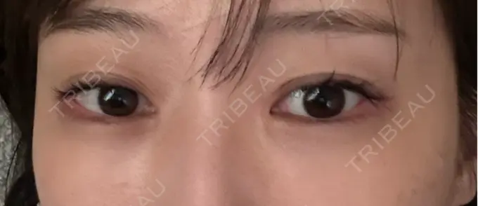 クマ治療 / 下まぶたの脂肪取り / 脂肪注入（目の下） セオリークリニック DAY 14 メイン用