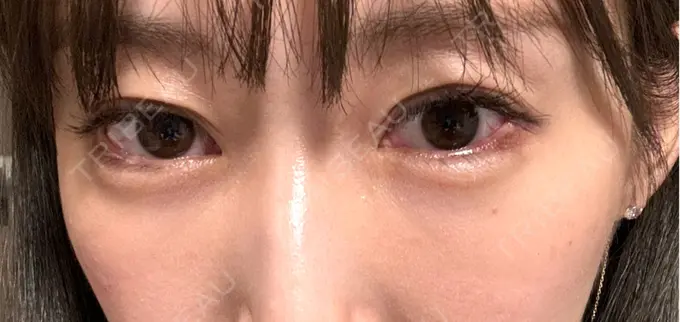 クマ治療 / 下まぶたの脂肪取り / 脂肪注入（目の下） セオリークリニック DAY 15 メイン用