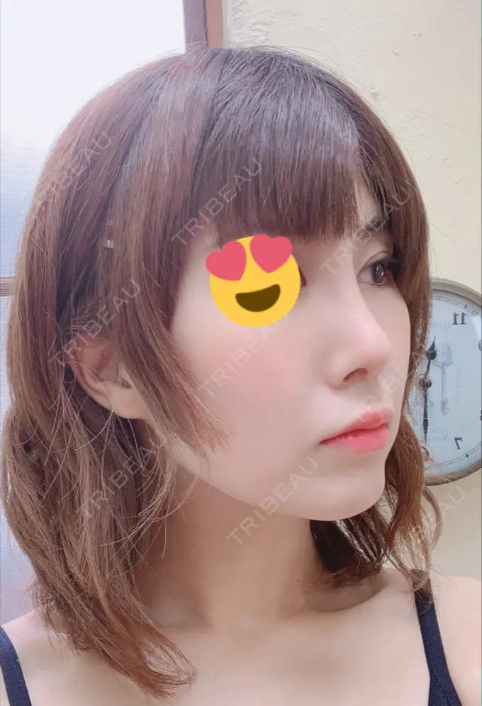 隆鼻術 / 鼻尖形成（切開） / 鼻中隔延長（切開） / 脂肪吸引（顔） / 軟骨移植 / プロテーゼ除去 / ヒアルロン酸注入（唇） ジュエリー美容外科 DAY 28 メイン用