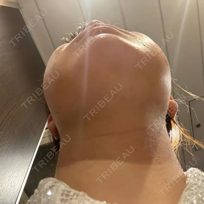 糸リフト / バッカルファット除去 / 脂肪吸引（顔） / メーラーファット除去 / ジョールファット除去 RIVER CLINIC（リバークリニック） DAY 4 メイン用