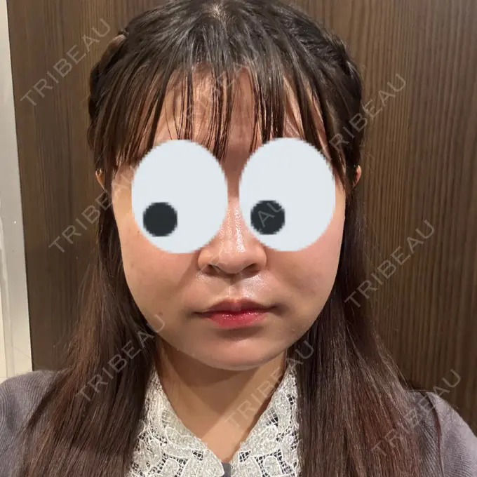 糸リフト / バッカルファット除去 / 脂肪吸引（顔） / メーラーファット除去 / ジョールファット除去 RIVER CLINIC（リバークリニック） DAY 4 メイン用