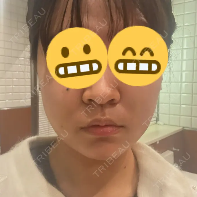 糸リフト / バッカルファット除去 / 脂肪吸引（顔） / メーラーファット除去 / ジョールファット除去 RIVER CLINIC（リバークリニック） DAY 5 メイン用