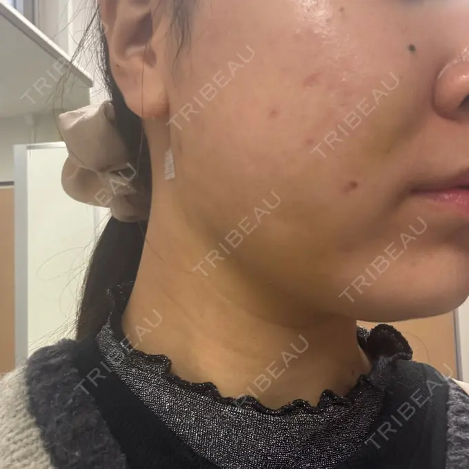 糸リフト / バッカルファット除去 / 脂肪吸引（顔） / メーラーファット除去 / ジョールファット除去 RIVER CLINIC（リバークリニック） DAY 6 メイン用