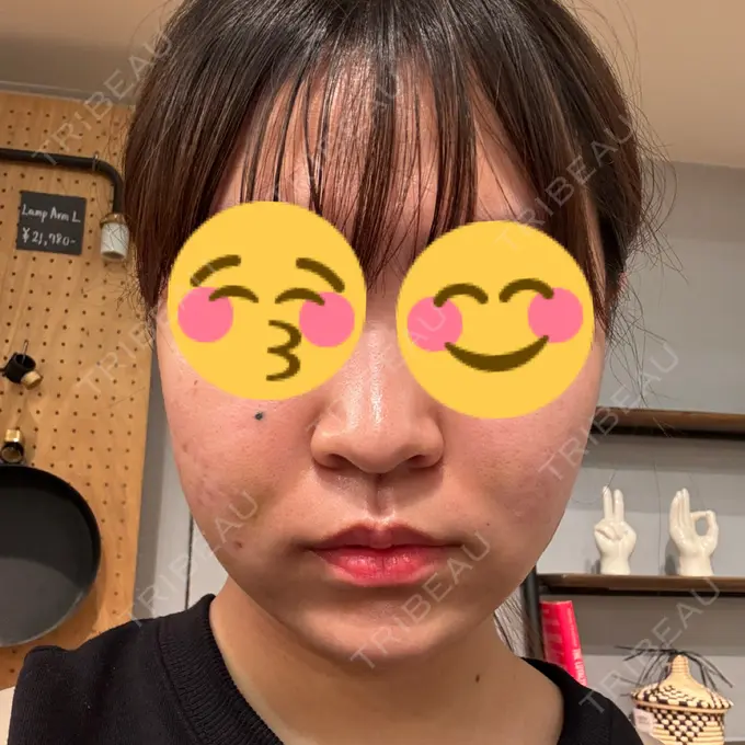 糸リフト / バッカルファット除去 / 脂肪吸引（顔） / メーラーファット除去 / ジョールファット除去 RIVER CLINIC（リバークリニック） DAY 7 メイン用