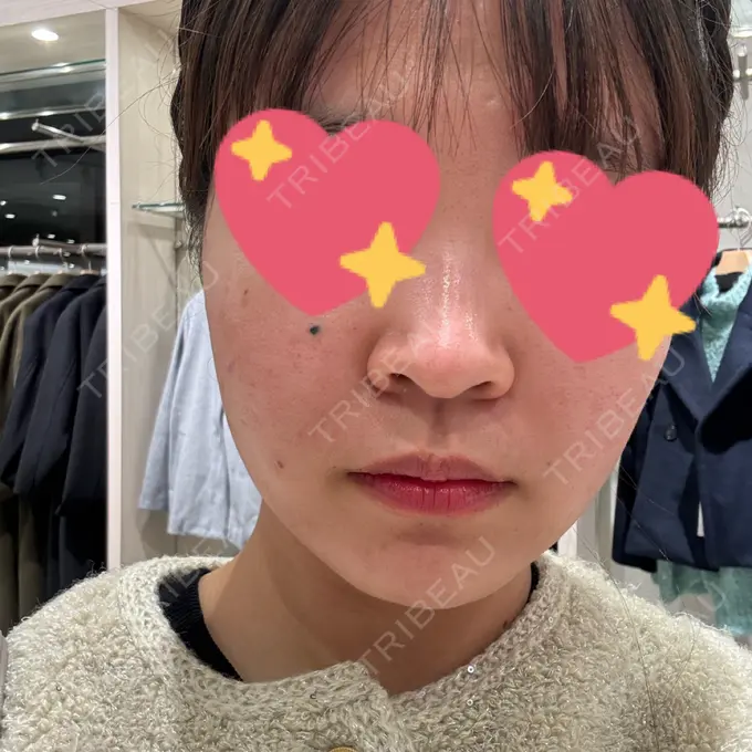 糸リフト / バッカルファット除去 / 脂肪吸引（顔） / メーラーファット除去 / ジョールファット除去 RIVER CLINIC（リバークリニック） AFTER メイン用