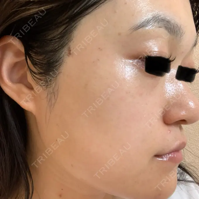 ボトックス（あご） / ボトックス（眉間） / イオン導入 / ピーリング（ハリ・ツヤ） / ルメッカ ルラ美容クリニック 仙台院 / ルラスキンクリニック 仙台院 DAY 4 メイン用