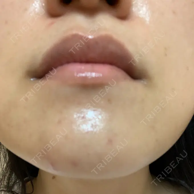 ボトックス（あご） / ボトックス（眉間） / イオン導入 / ピーリング（ハリ・ツヤ） / ルメッカ ルラ美容クリニック 仙台院 / ルラスキンクリニック 仙台院 DAY 4 メイン用