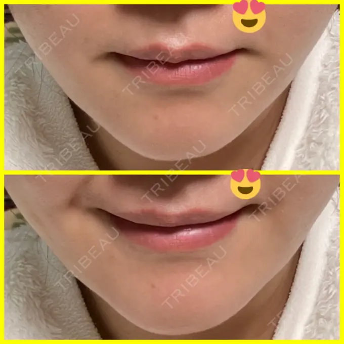 ボトックス（口角） / ボトックス（額） 東京美容医療クリニック 池袋院 DAY 7 メイン用