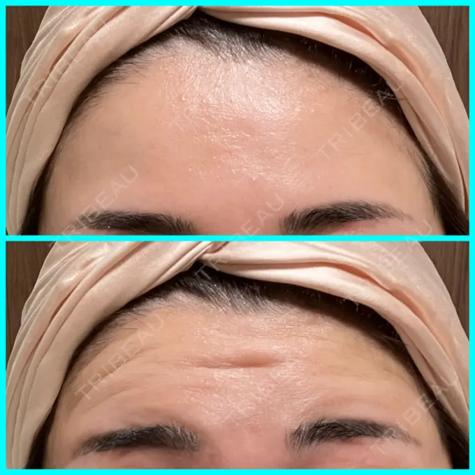 ボトックス（口角） / ボトックス（額） 東京美容医療クリニック 池袋院 DAY 7 メイン用