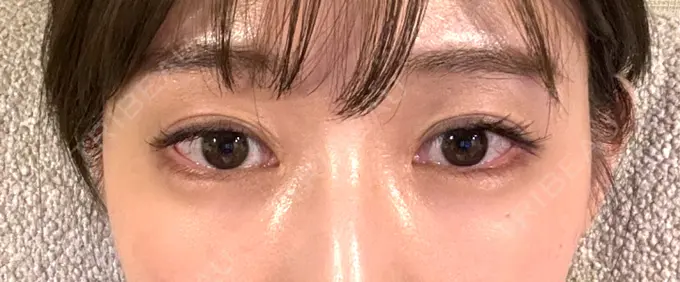 クマ治療 / 下まぶたの脂肪取り / 脂肪注入（目の下） セオリークリニック DAY 16 メイン用