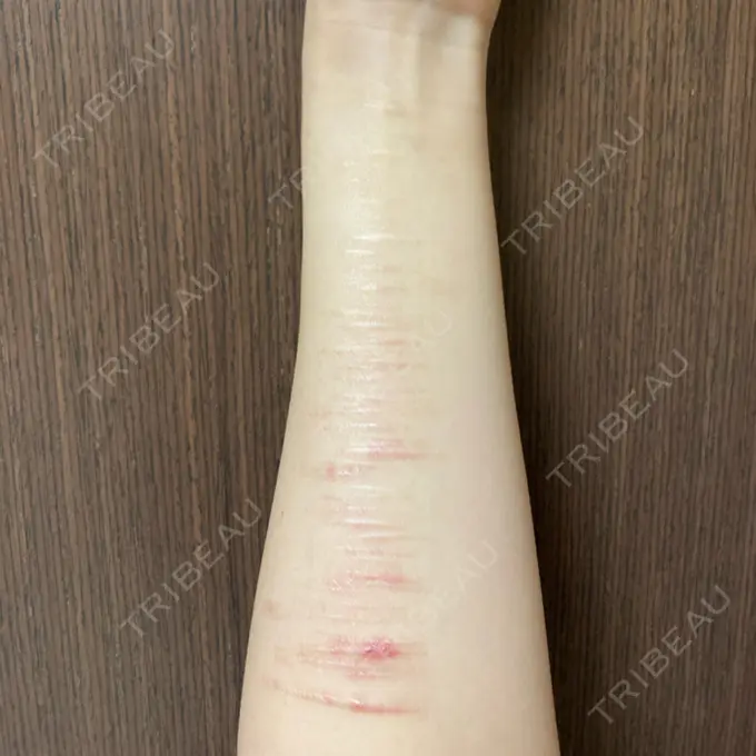 傷跡修正 きずときずあとのクリニック 銀座院 AFTER メイン用