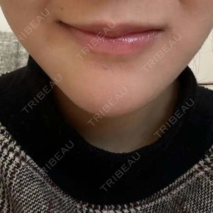 ボトックス（エラ・小顔） 筋肉・美容クリニック DAY 7 メイン用