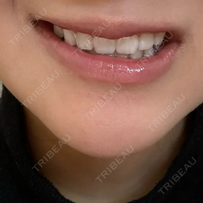 ボトックス（エラ・小顔） 筋肉・美容クリニック DAY 7 メイン用