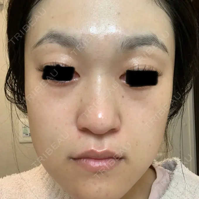 ボトックス（あご） / ボトックス（眉間） / イオン導入 / ピーリング（ハリ・ツヤ） / ルメッカ ルラ美容クリニック 仙台院 / ルラスキンクリニック 仙台院 DAY 5 メイン用