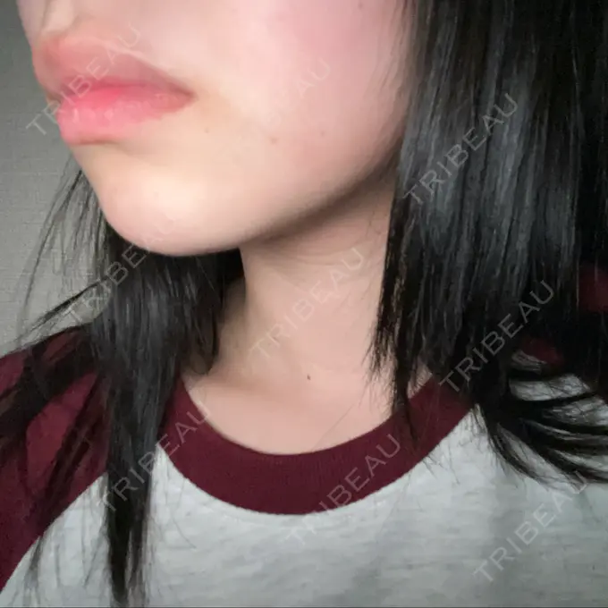 RF（高周波）たるみ治療 / その他（輪郭） 大美会クリニック 神戸院 AFTER メイン用