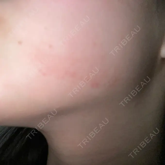 RF（高周波）たるみ治療 / その他（輪郭） 大美会クリニック 神戸院 DAY 0 メイン用