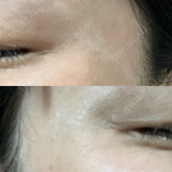 ボトックス（目尻） 湘南美容クリニック 立川院 DAY 22 メイン用