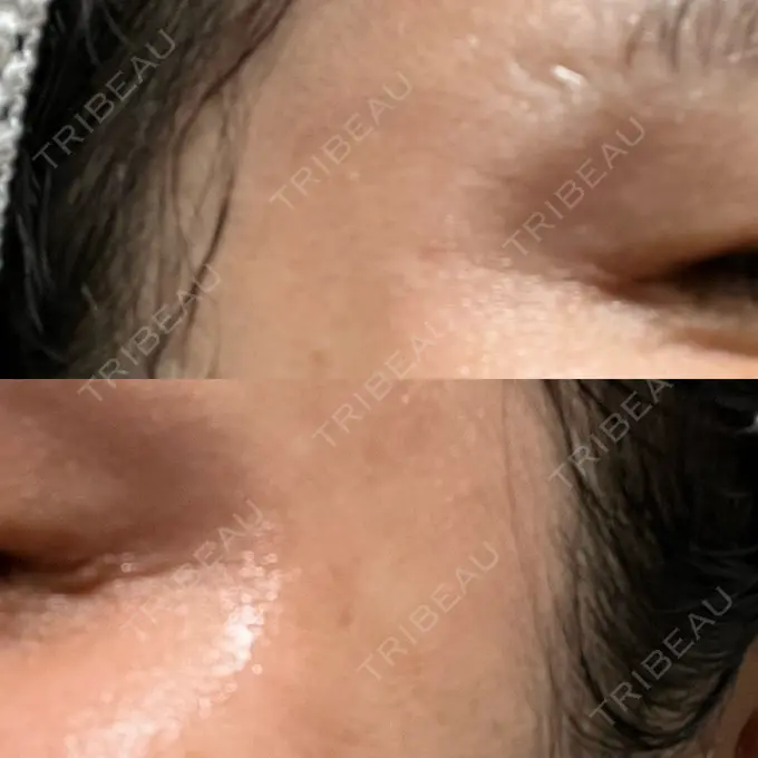 ボトックス（目尻） 湘南美容クリニック 立川院 DAY 19 メイン用