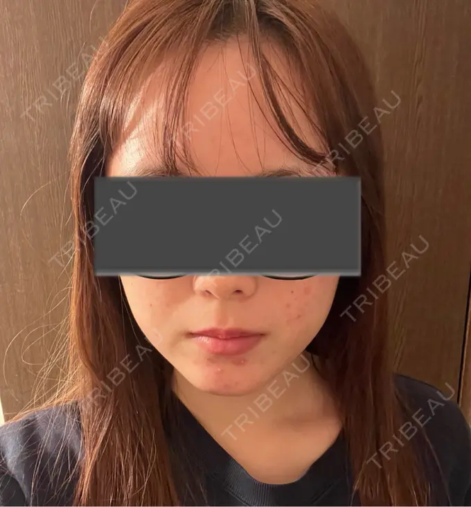 脂肪吸引（顔） Mods Clinic（モッズクリニック） 名古屋院 DAY 33 メイン用