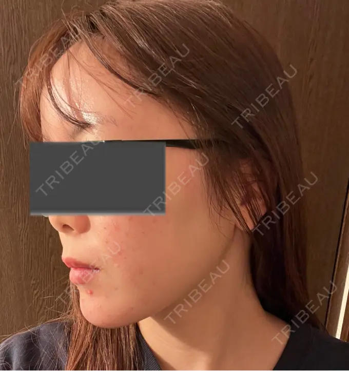 脂肪吸引（顔） Mods Clinic（モッズクリニック） 名古屋院 DAY 33 メイン用