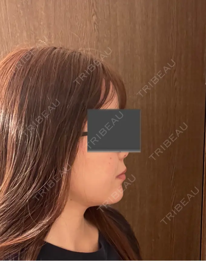 脂肪吸引（顔） Mods Clinic（モッズクリニック） 名古屋院 DAY 33 メイン用