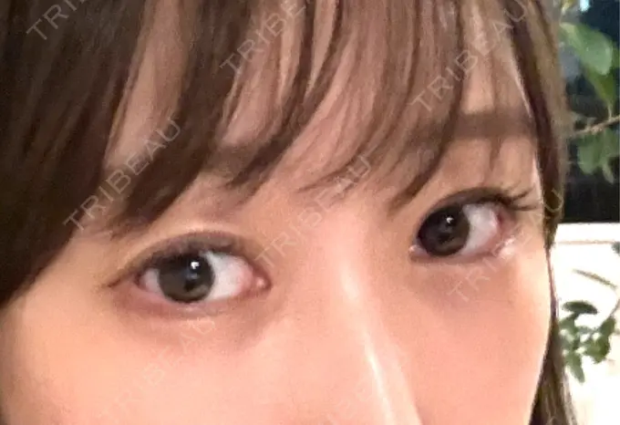 クマ治療 / 下まぶたの脂肪取り / 脂肪注入（目の下） セオリークリニック AFTER メイン用