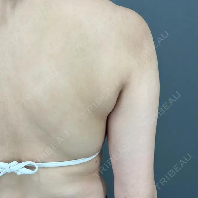 脂肪吸引（背中） ziz CLINIC DAY 90 メイン用