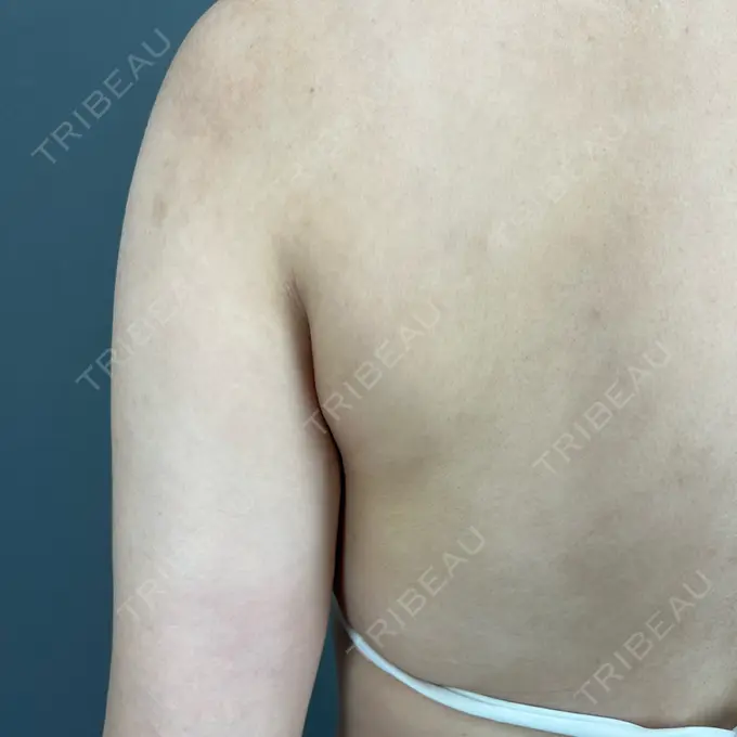 脂肪吸引（背中） ziz CLINIC DAY 90 メイン用