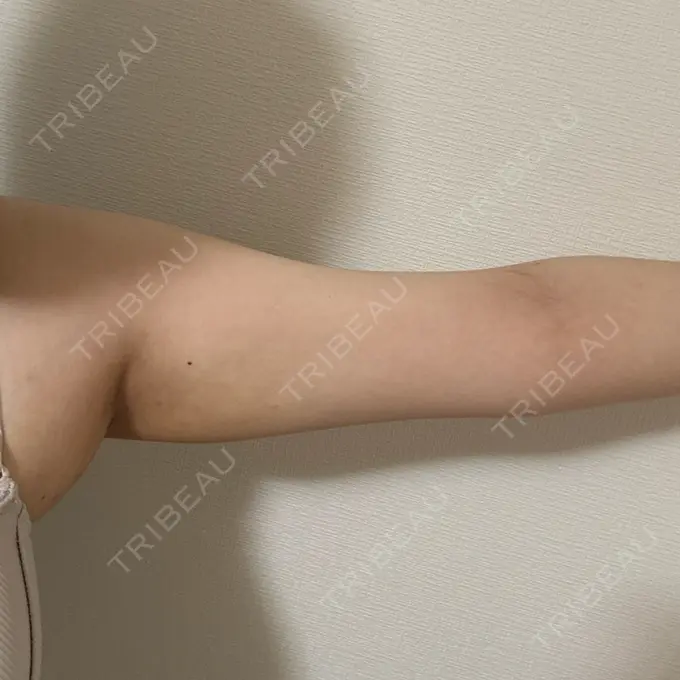 脂肪吸引（二の腕） Mods Clinic（モッズクリニック） 名古屋院 DAY 0 メイン用