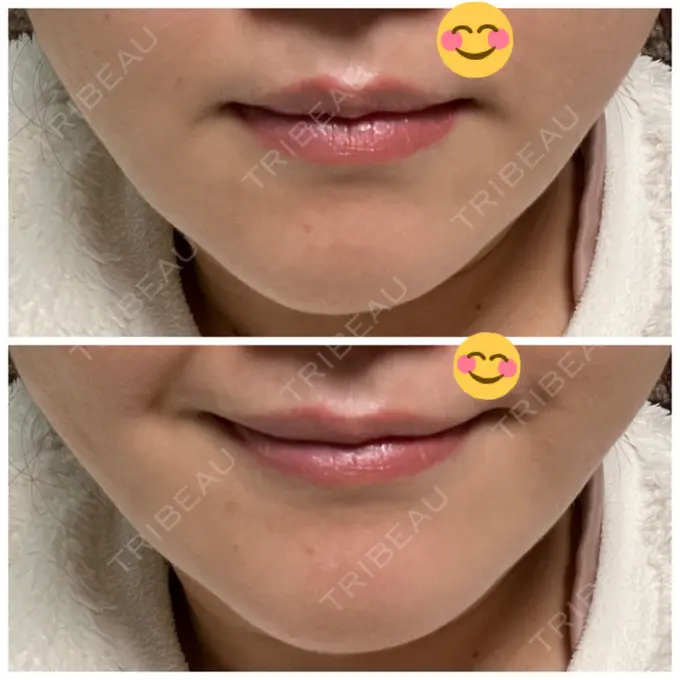 ボトックス（口角） / ボトックス（額） 東京美容医療クリニック 池袋院 DAY 9 メイン用