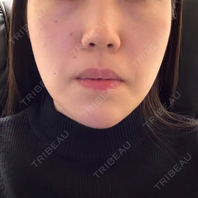 糸リフト / ヒアルロン酸注入（あご） L‘amour clinic Tokyo【ラムールクリニック東京】 DAY 3 メイン用