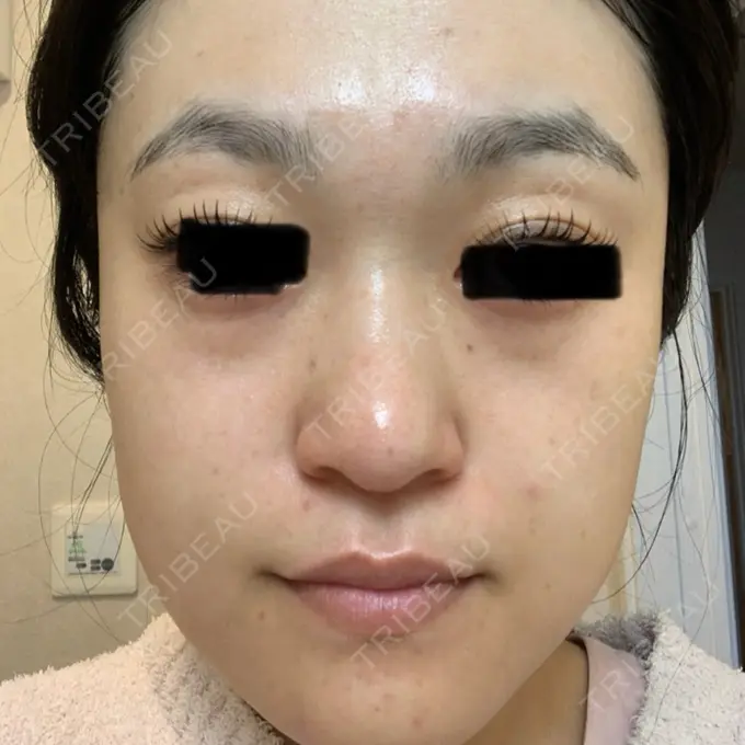 ボトックス（あご） / ボトックス（眉間） / イオン導入 / ピーリング（ハリ・ツヤ） / ルメッカ ルラ美容クリニック 仙台院 / ルラスキンクリニック 仙台院 AFTER メイン用