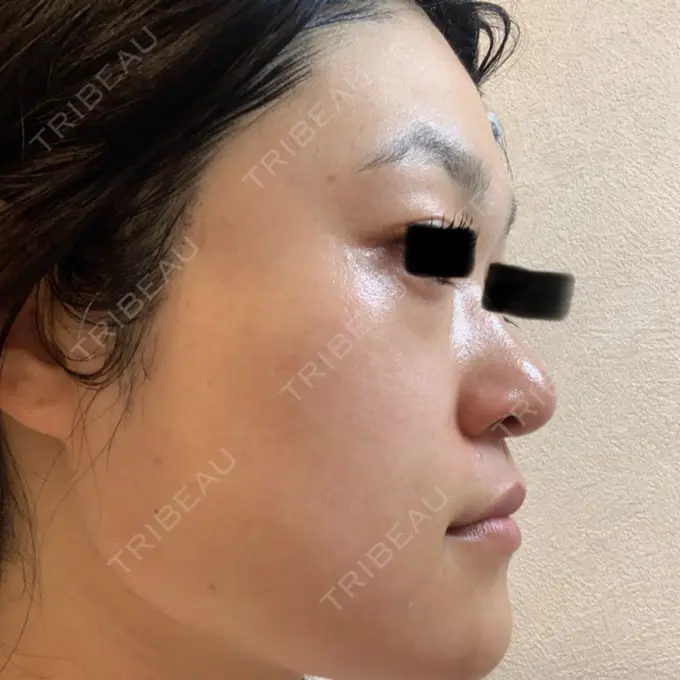 ボトックス（あご） / ボトックス（眉間） / イオン導入 / ピーリング（ハリ・ツヤ） / ルメッカ ルラ美容クリニック 仙台院 / ルラスキンクリニック 仙台院 DAY 6 メイン用