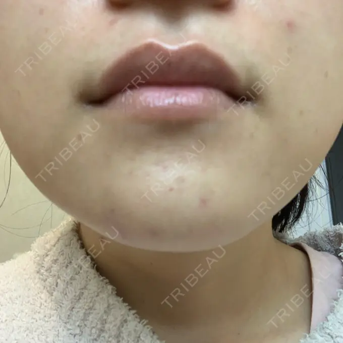 ボトックス（あご） / ボトックス（眉間） / イオン導入 / ピーリング（ハリ・ツヤ） / ルメッカ ルラ美容クリニック 仙台院 / ルラスキンクリニック 仙台院 DAY 6 メイン用