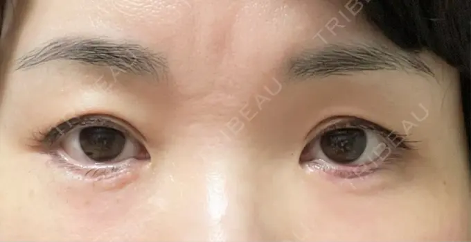 ヒアルロン酸注入（涙袋） 新未来クリニック DAY 0 メイン用