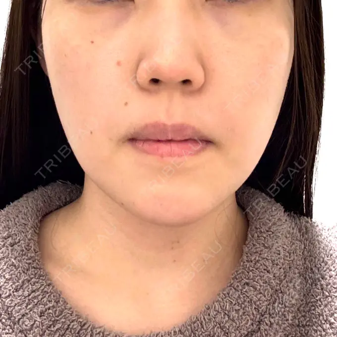 糸リフト / ヒアルロン酸注入（あご） L‘amour clinic Tokyo【ラムールクリニック東京】 DAY 4 メイン用